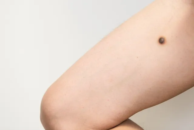秋田でほくろ除去クリニックを選ぶ3つのポイント
