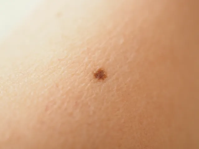 ほくろの写真
