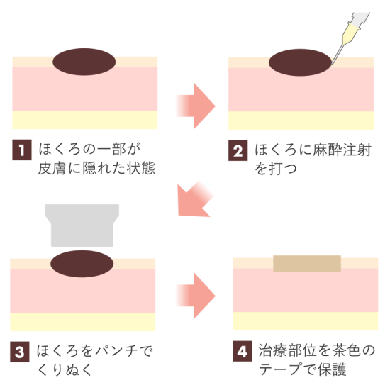 秋田皮膚科のほくろ除去の流れ