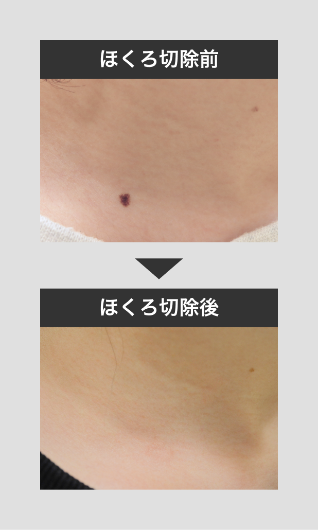 ほくろ除去の症例写真