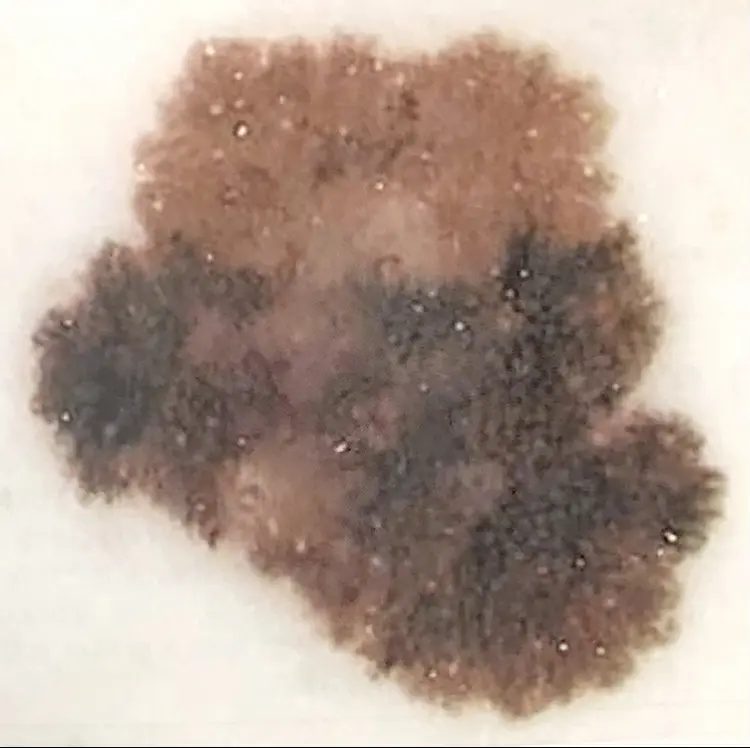 ダーモスコピーの写真