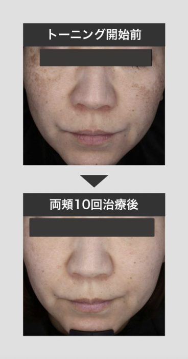 レーザートーニングの症例写真