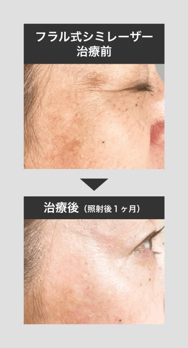 シミレーザーの症例写真