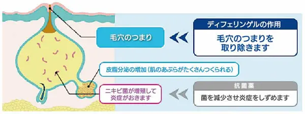 ディフェリンゲル